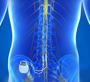 Spinal Cord (DCS) & Peripheral Stimulation